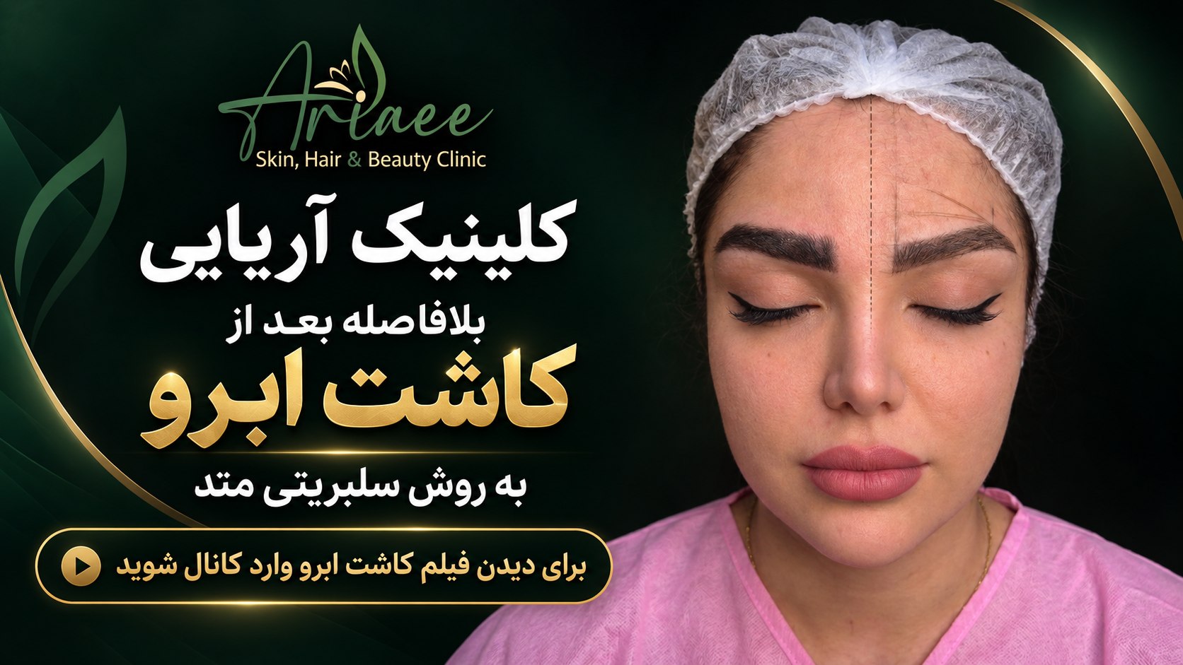کاشت ابرو با موهای بلند👇فیلم کاشت رو ببین🥰