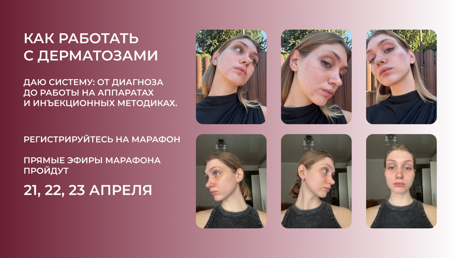 antiacne.pro